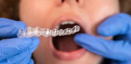Can Invisalign Correct an Underbite?
