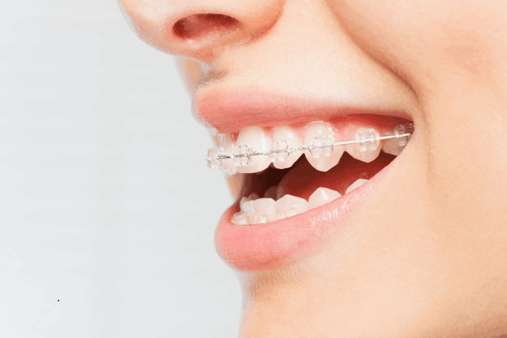 must known tips with braces