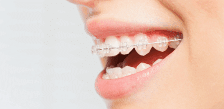 Starting Braces? Here Are 3 Must-Know Tips