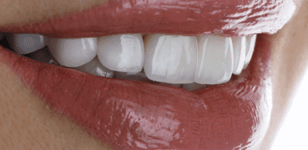 Explained: The Working Mechanism of Veneers