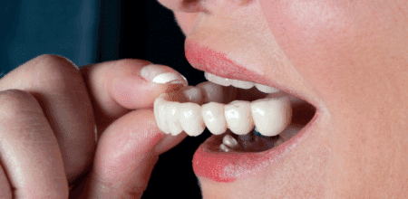 Temporary Teeth Options While Your Implants Heal