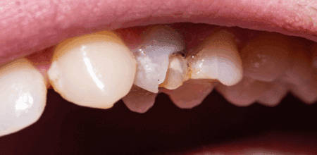 Best Materials for Dental Repairs After a Chipped Tooth