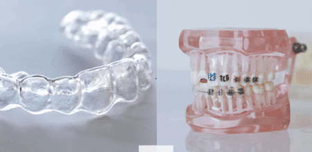 Invisalign vs. Braces: Do They Work Equally Well?