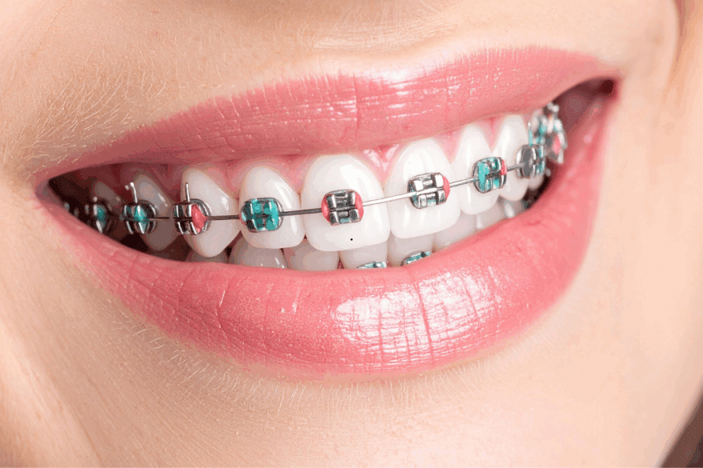 Braces Correct Jaw Alignment and Transform Your Smile