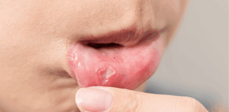 Is That Mouth Sore a Minor Annoyance or a Major Concern?