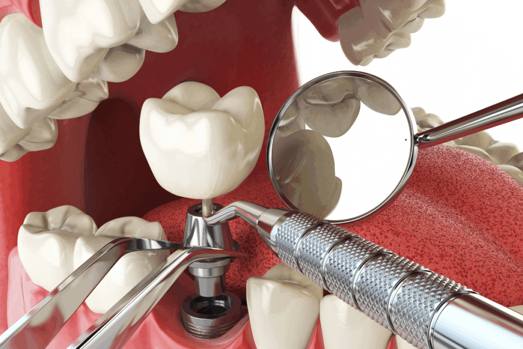 Dental Implants Jupiter