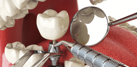 Can’t Afford Dental Implants? Explore Other Tooth Replacement Options in Jupiter