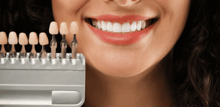 Avoid the “Fake Smile” Look: How to Get Natural-Looking Veneers