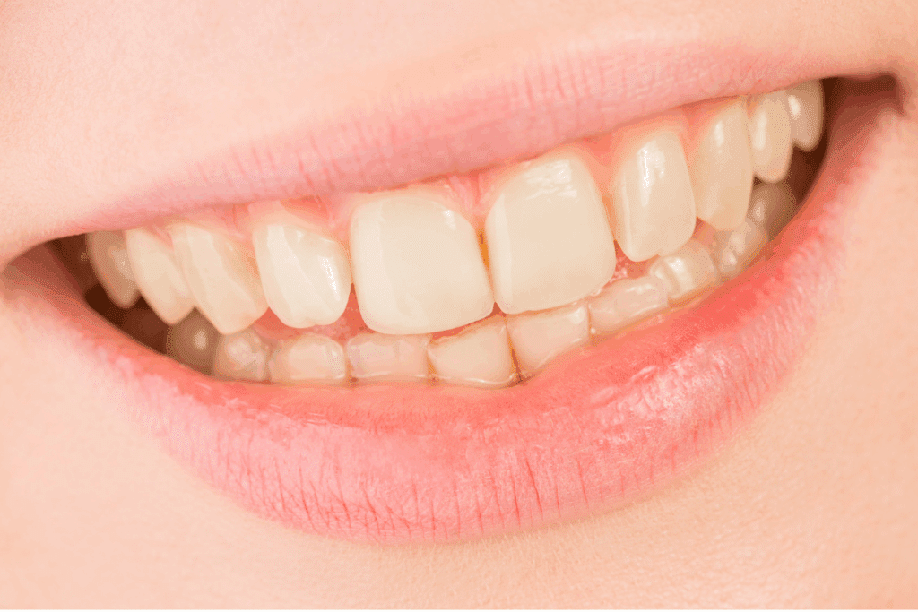 Tooth Looks Yellow After White Spot Treatment
