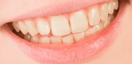 Why Your Tooth Looks Yellow After White Spot Treatment