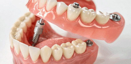 Implant Concerns? Get the Facts and Peace of Mind