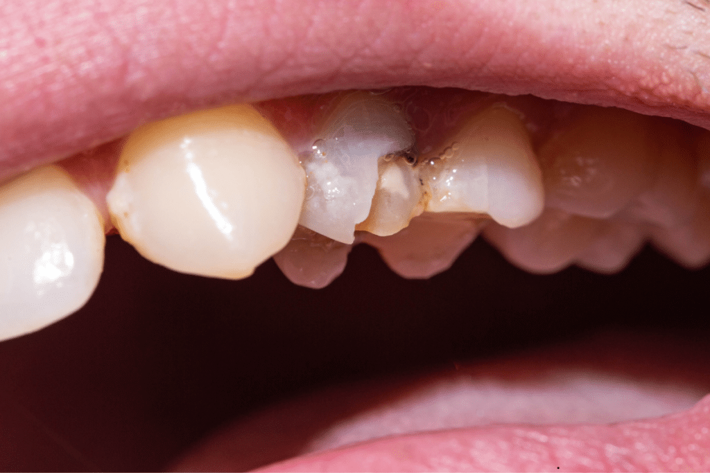 Chipped teeth