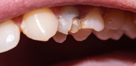 Fixing Chipped or Uneven Teeth: How a Cosmetic Dentist Can Help