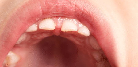 What Is the Best Way to Fix Small Teeth?